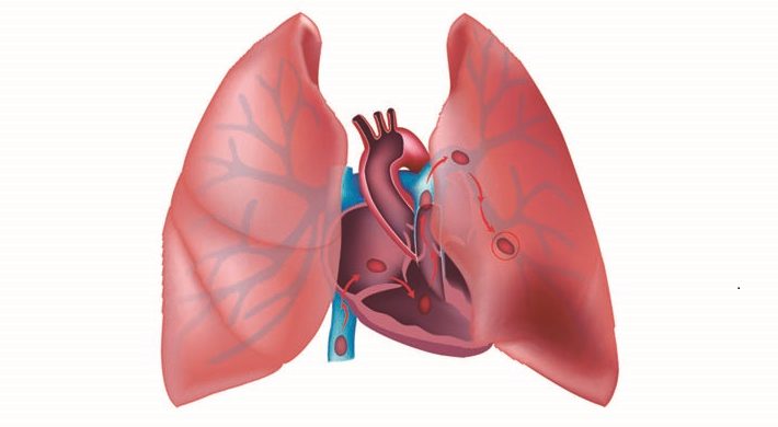 Tromboembolismo pulmonar y tumor retroperitoneal